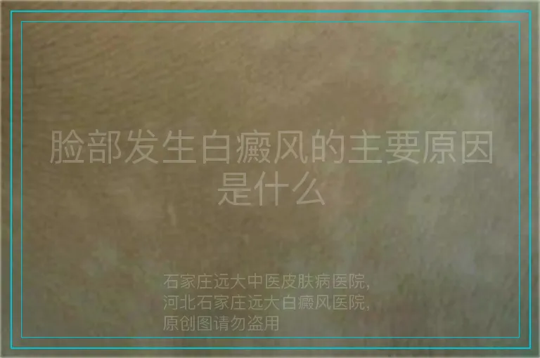 脸部发生白癜风的主要原因是什么