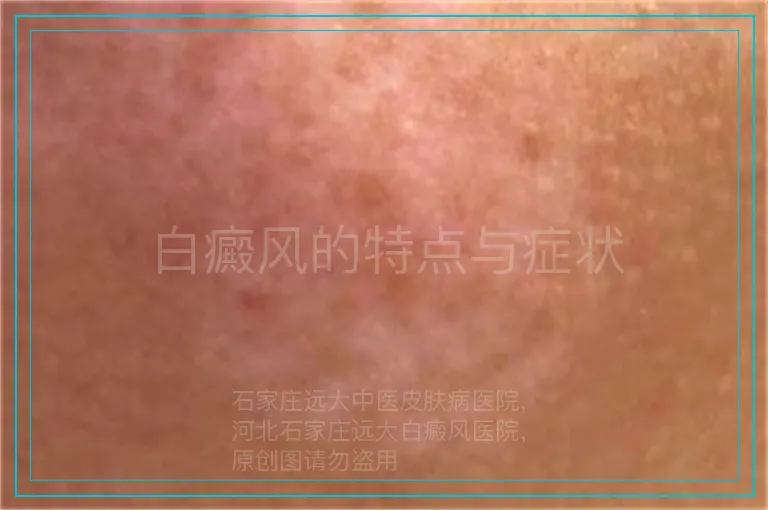 白癜风的特点与症状