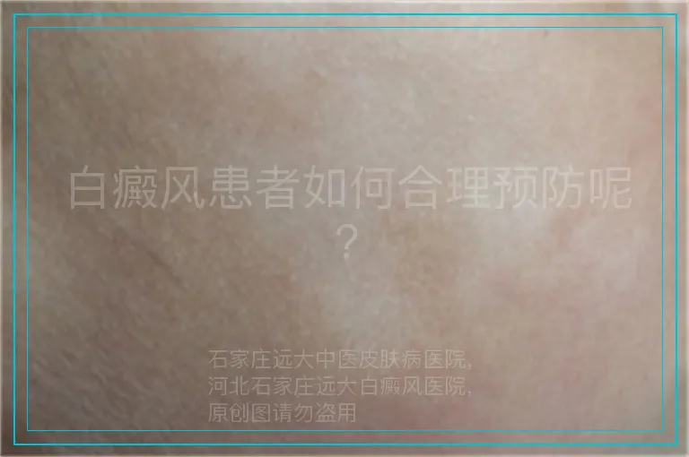 白癜风患者如何合理预防呢?