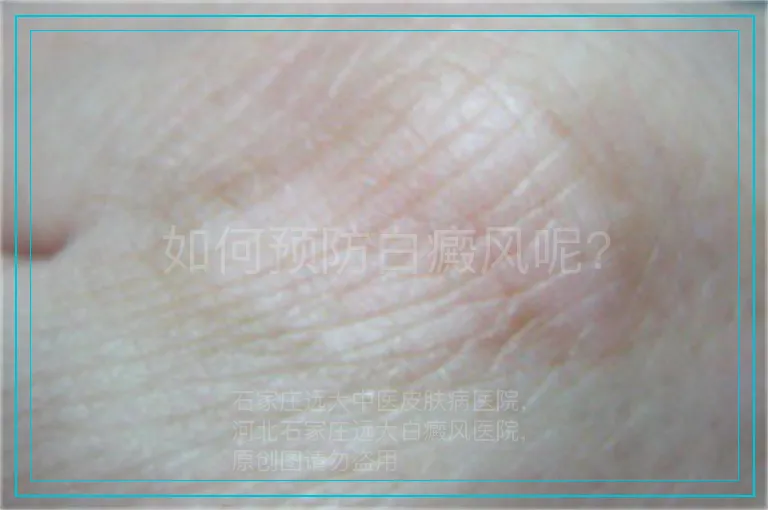 如何预防白癜风呢?