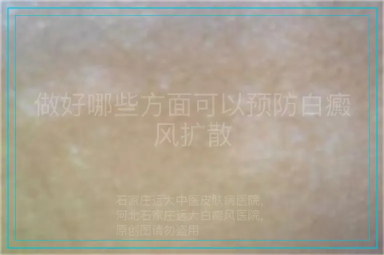 做好哪些方面可以预防白癜风扩散