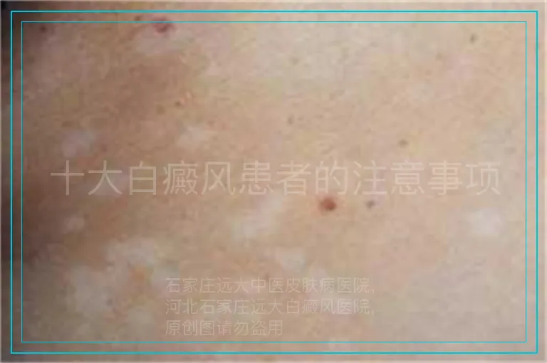 十大白癜风患者的注意事项