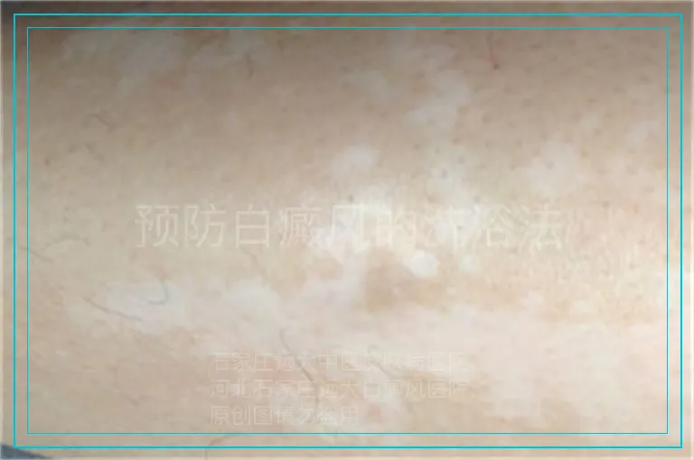 预防白癜风的洗浴法