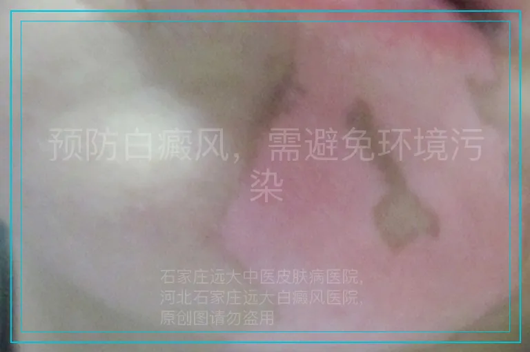 预防白癜风，需避免环境污染