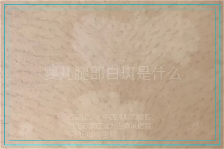 婴儿腿部白斑是什么