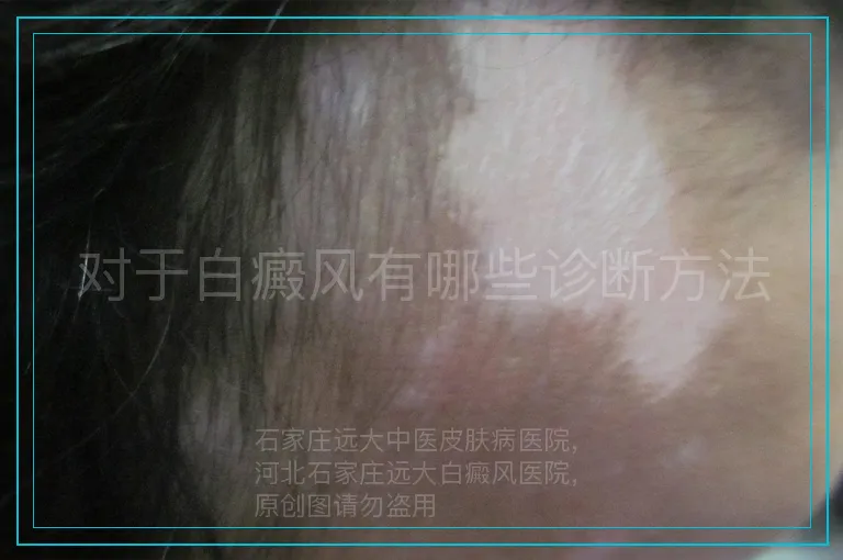 对于白癜风有哪些诊断方法