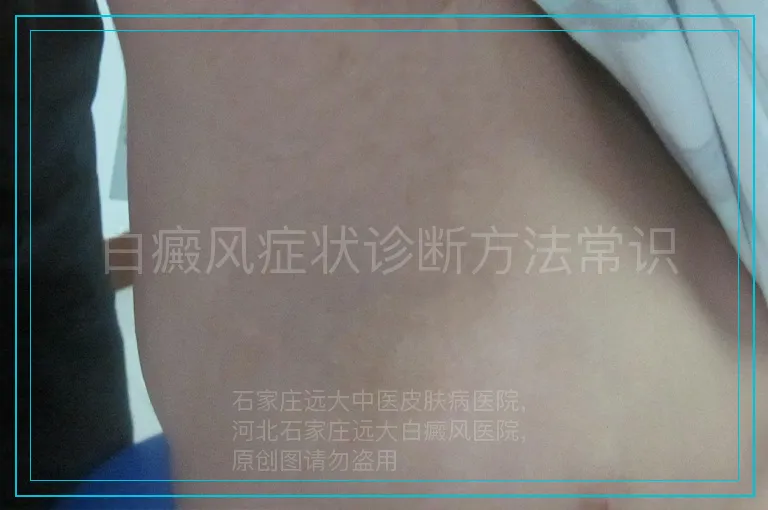 白癜风症状诊断方法常识
