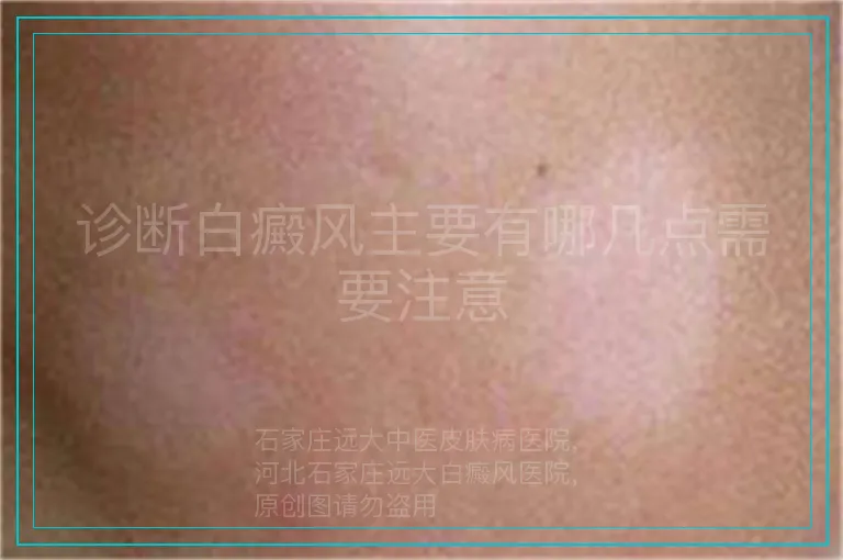 诊断白癜风主要有哪几点需要注意