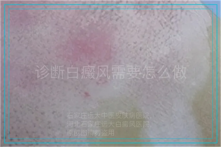 诊断白癜风需要怎么做