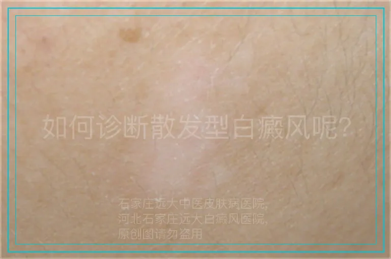 如何诊断散发型白癜风呢？