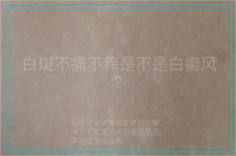 白斑不痛不痒是不是白癜风？