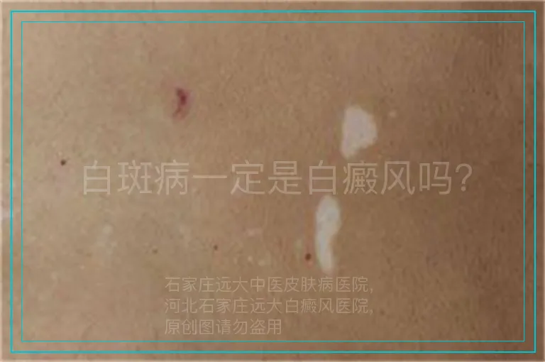 白斑病一定是白癜风吗？