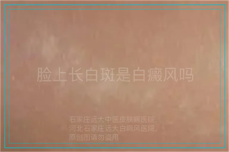 脸上长白斑是白癜风吗
