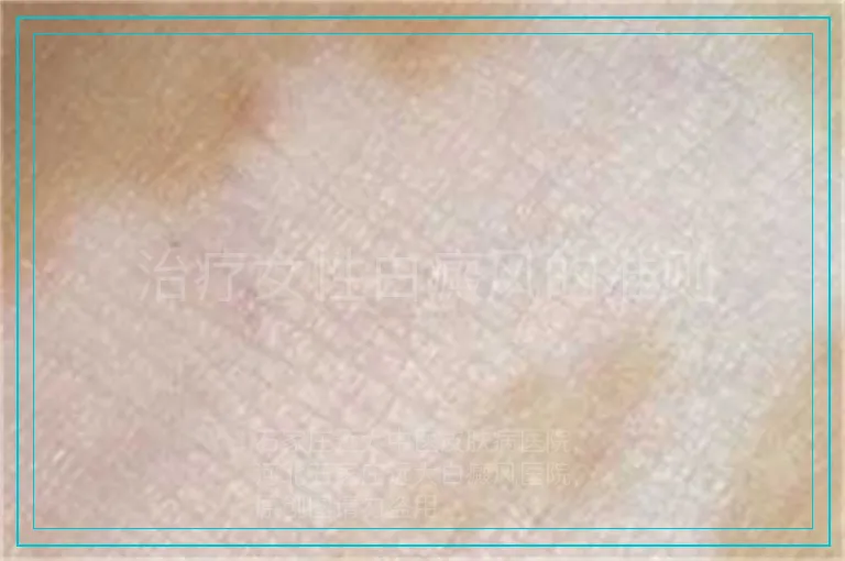 治疗女性白癜风的准则