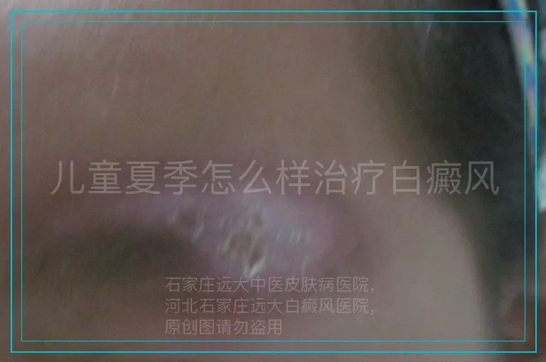 儿童夏季怎么样治疗白癜风