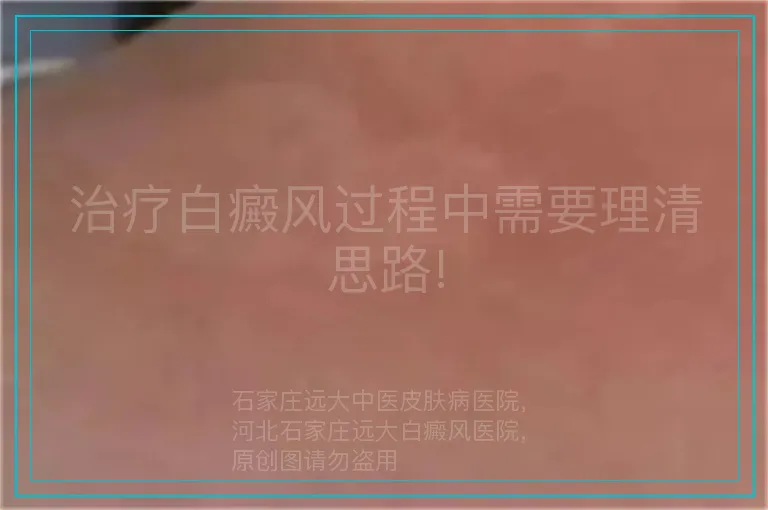 治疗白癜风过程中需要理清思路!