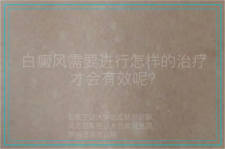白癜风需要进行怎样的治疗才会有效呢?