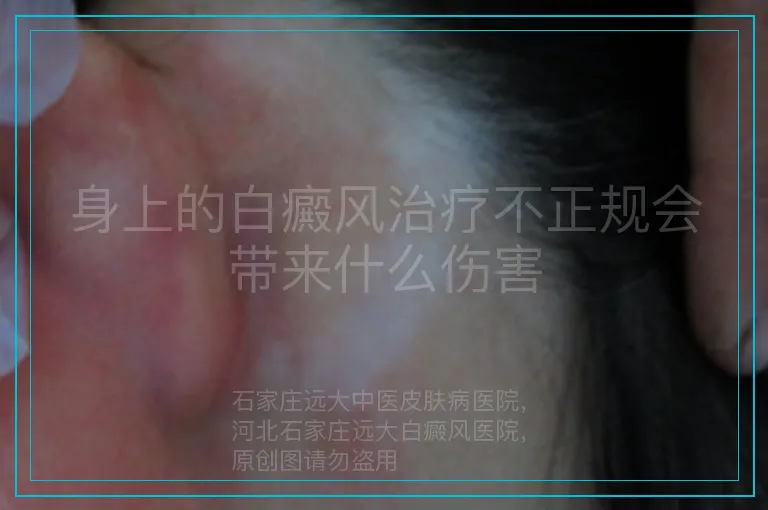身上的白癜风治疗不正规会带来什么伤害