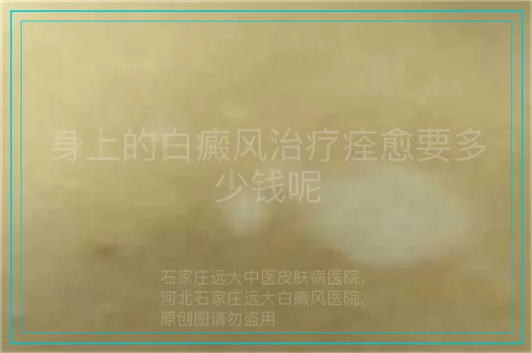 身上的白癜风治疗痊愈要多少钱呢