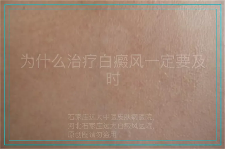 为什么治疗白癜风一定要及时