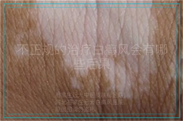 不正规的治疗白癜风会有哪些后果