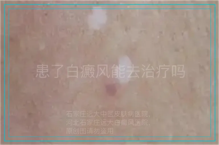 患了白癜风能去治疗吗