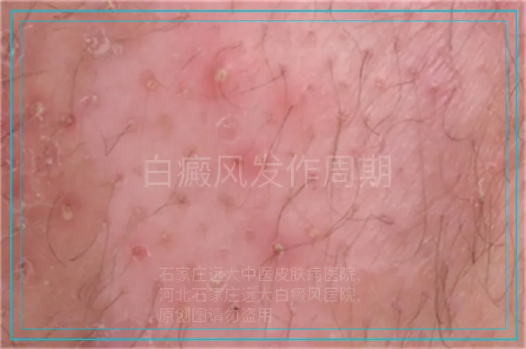 白癜风发作周期