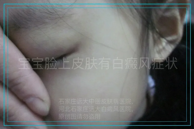 宝宝脸上皮肤有白癜风症状