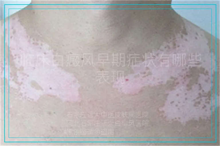 临床白癜风早期症状有哪些表现