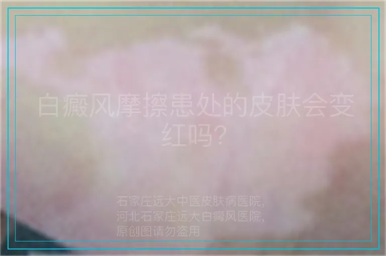 白癜风摩擦患处的皮肤会变红吗？