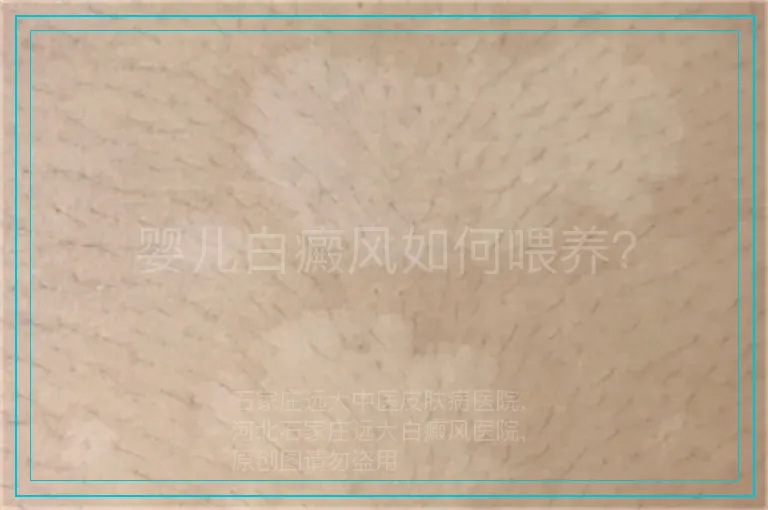 婴儿白癜风如何喂养？