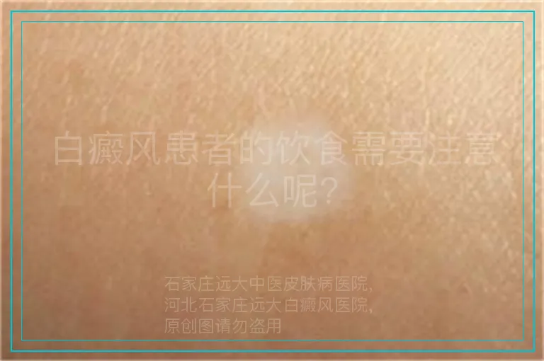 白癜风患者的饮食需要注意什么呢?