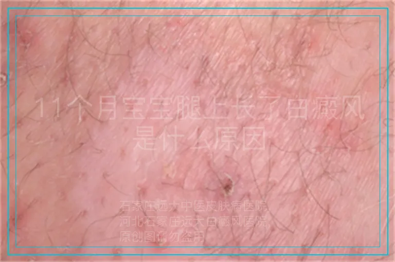 11个月宝宝腿上长了白癜风是什么原因