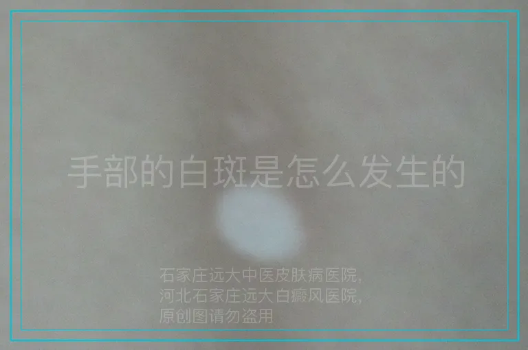 手部的白斑是怎么发生的