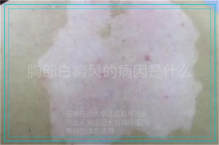 胸部白癜风的病因是什么