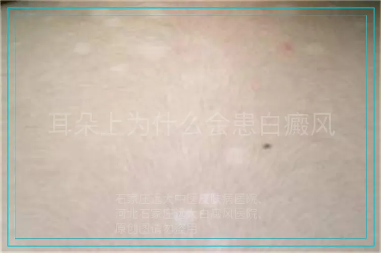 耳朵上为什么会患白癜风
