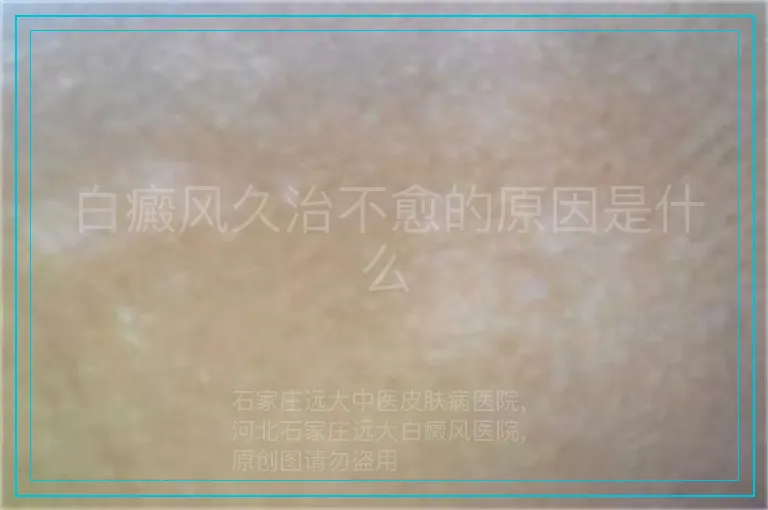 白癜风久治不愈的原因是什么