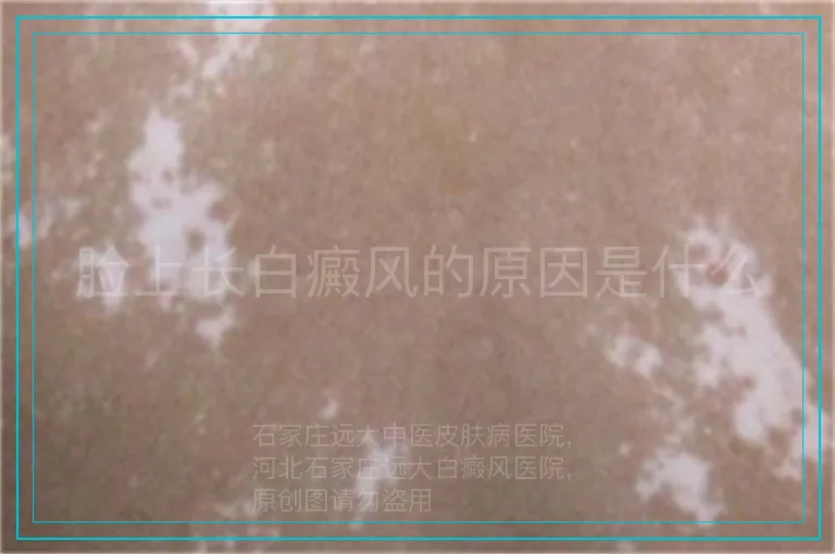 脸上长白癜风的原因是什么