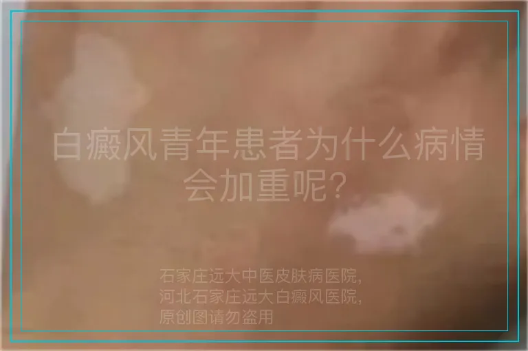 白癜风青年患者为什么病情会加重呢?