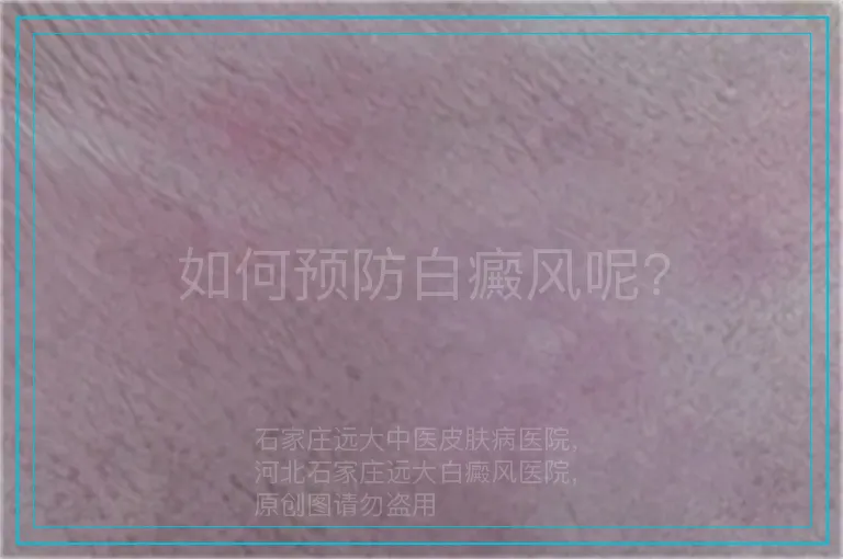 如何预防白癜风呢?