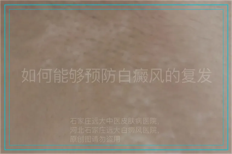 如何能够预防白癜风的复发