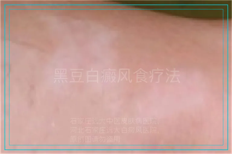 黑豆白癜风食疗法