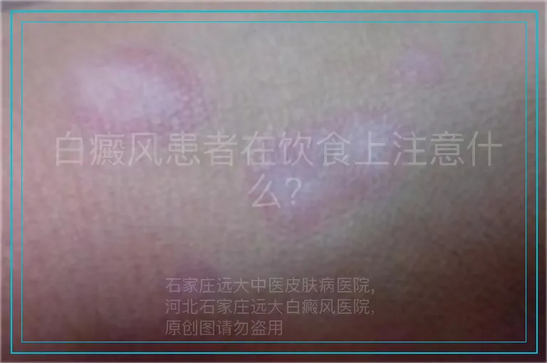 白癜风患者在饮食上注意什么?