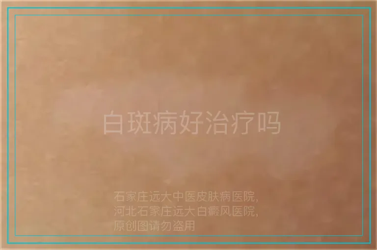 白斑病好治疗吗