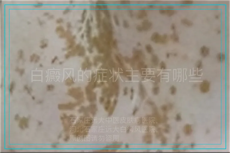 白癜风的症状主要有哪些