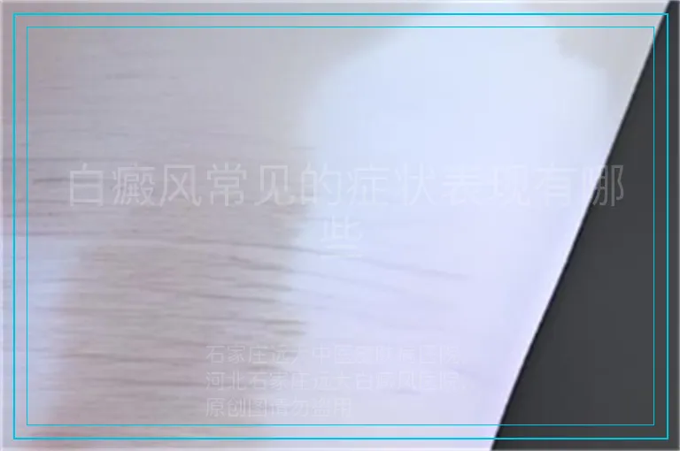 白癜风常见的症状表现有哪些