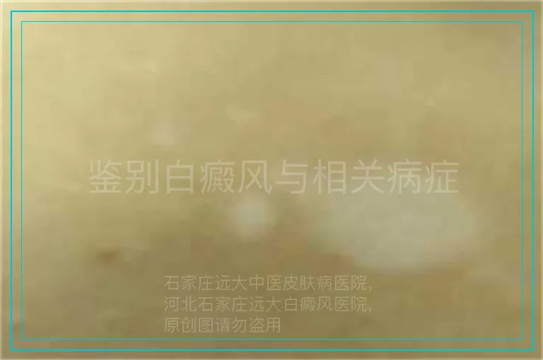 鉴别白癜风与相关病症