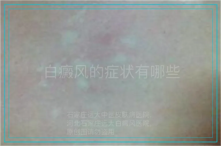 白癜风的症状有哪些