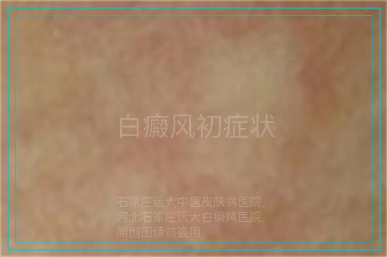 白癜风初症状