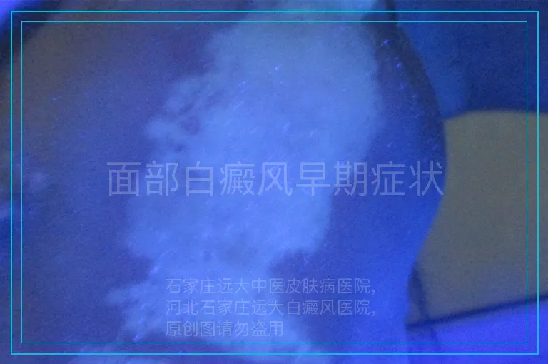 面部白癜风早期症状